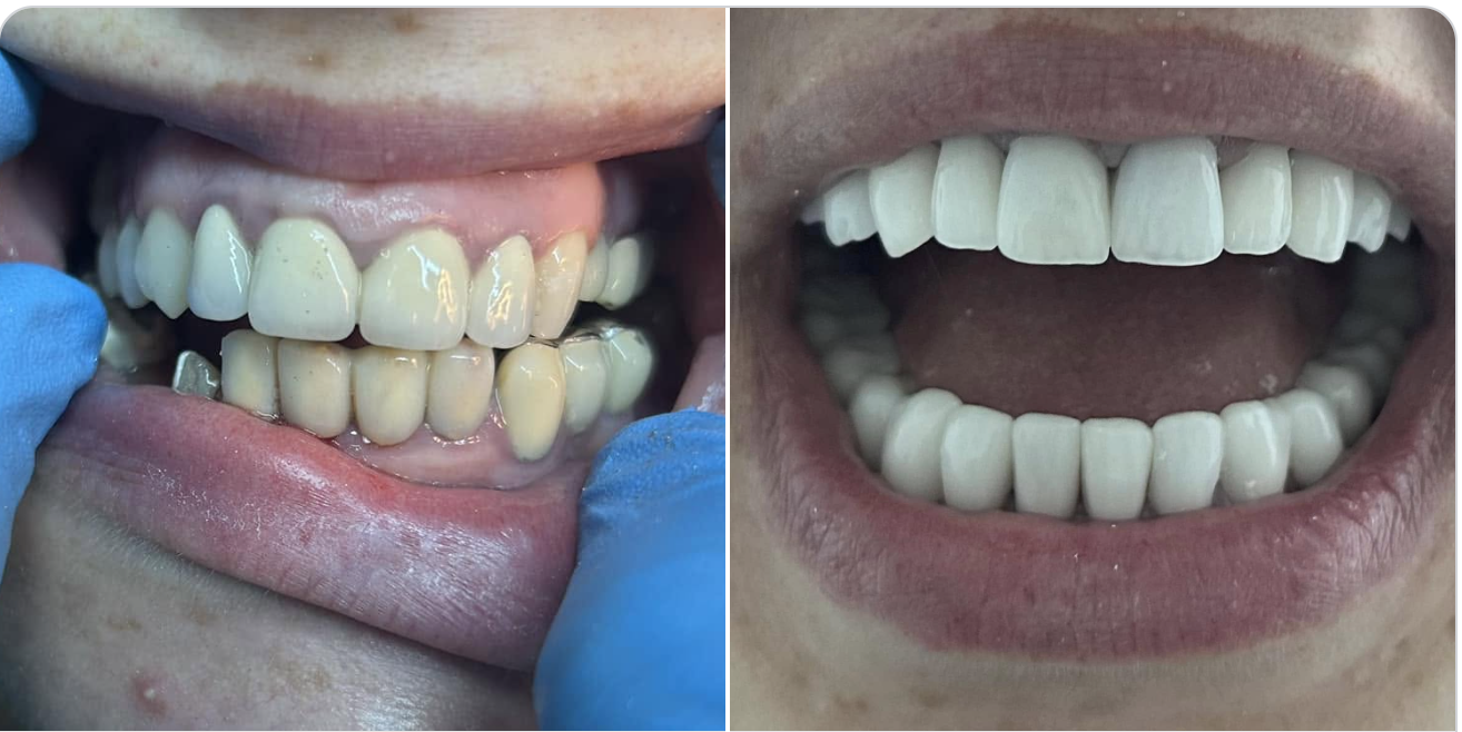Reconstrucție estetică cu coroane ceramice